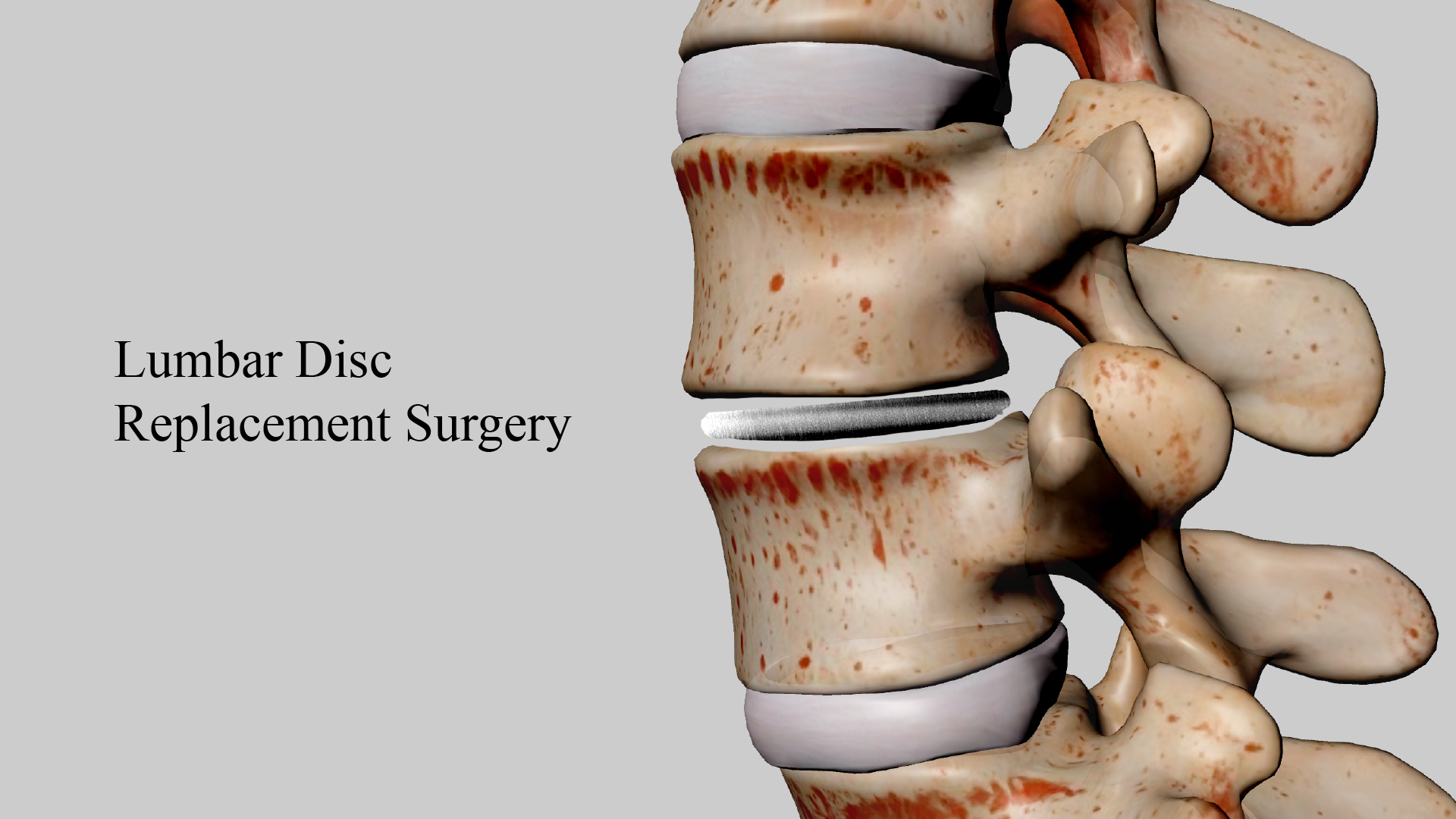 Lumbar Disc Replacement Surgery: A Modern Medical Breakthrough