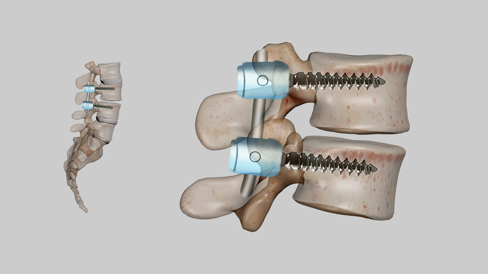 Comprehensive Guide to Spinal Fusion Surgery: Indications, Procedure, and Recovery